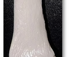 <p>Styloid process of ulna</p>