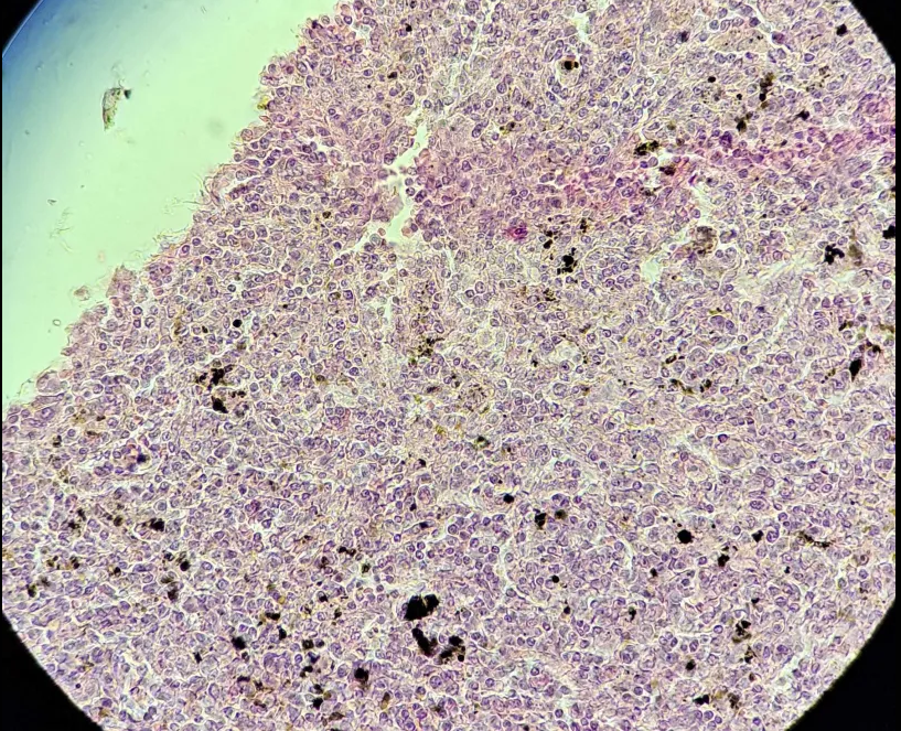 <p><span data-name="microscope" data-type="emoji">🔬</span><span data-name="petri_dish" data-type="emoji">🧫</span><strong><span> </span>Na podstawie zdjęcia preparatu:</strong></p><p></p><ul><li><p><span data-name="book" data-type="emoji">📖</span><span> </span>rozpoznaj gatunek pasożyta;</p></li></ul><p></p><ul><li><p><span data-name="recycle" data-type="emoji">♻</span><span> </span>rozpoznaj wszystkie formy rozwojowe;</p></li></ul><p></p><ul><li><p><span data-name="microbe" data-type="emoji">🦠</span><span> </span>wskaż organelle i cechy charakterystyczne dla danego gatunku;</p></li></ul><p></p><ul><li><p><span data-name="mask" data-type="emoji">😷</span><span> </span>nazwij chorobę, którą pasożyt wywołuje.</p></li></ul><p></p>