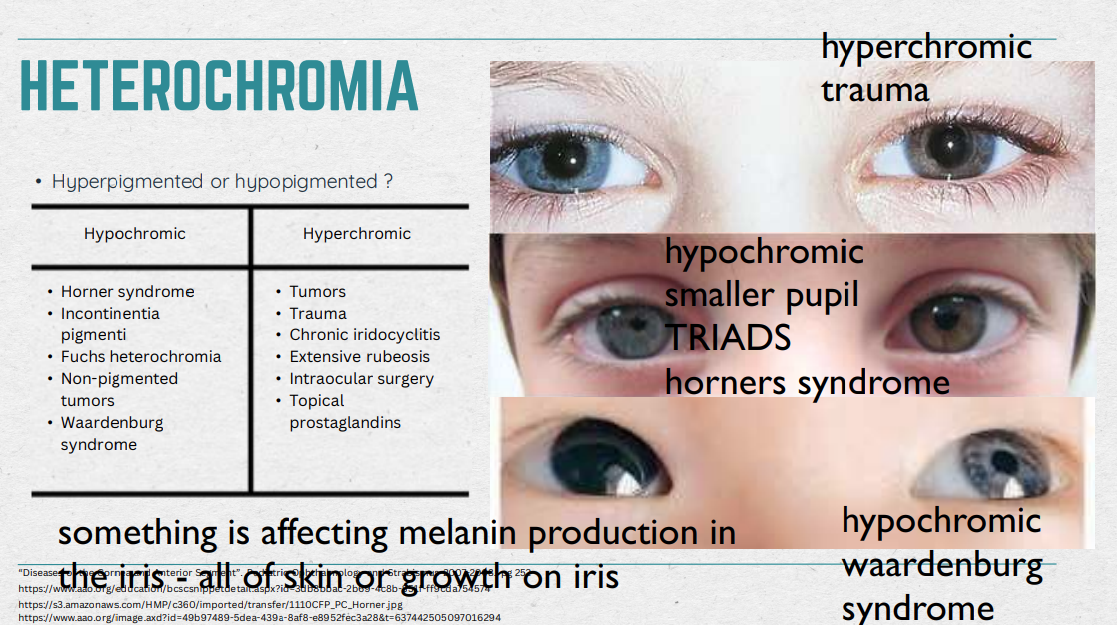 <ul><li><p>smtg. is affecting melanin production in the iris - all of skin or growth on iris</p></li></ul><p></p>