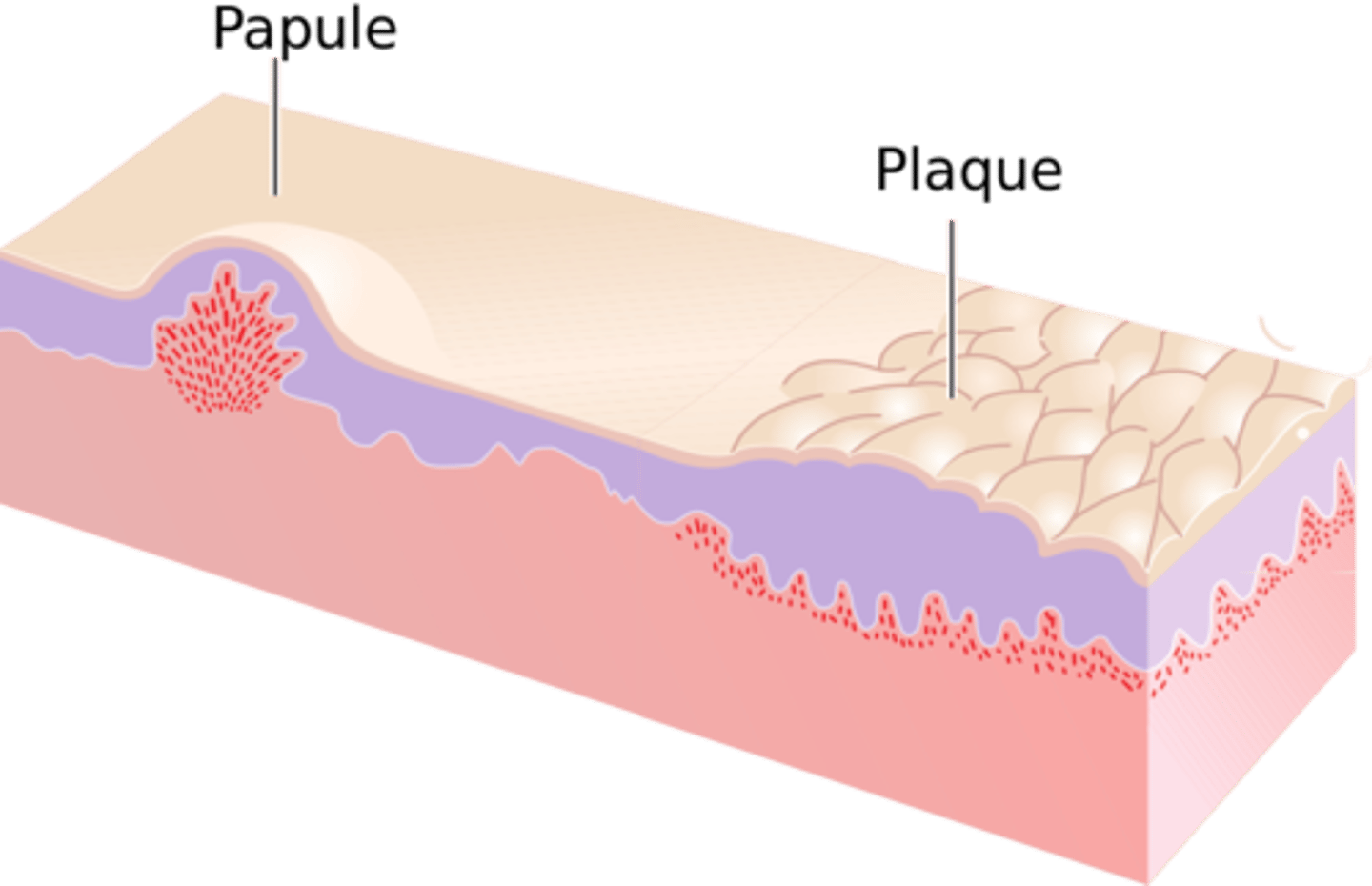 <p>Papule (primary lesion)</p>