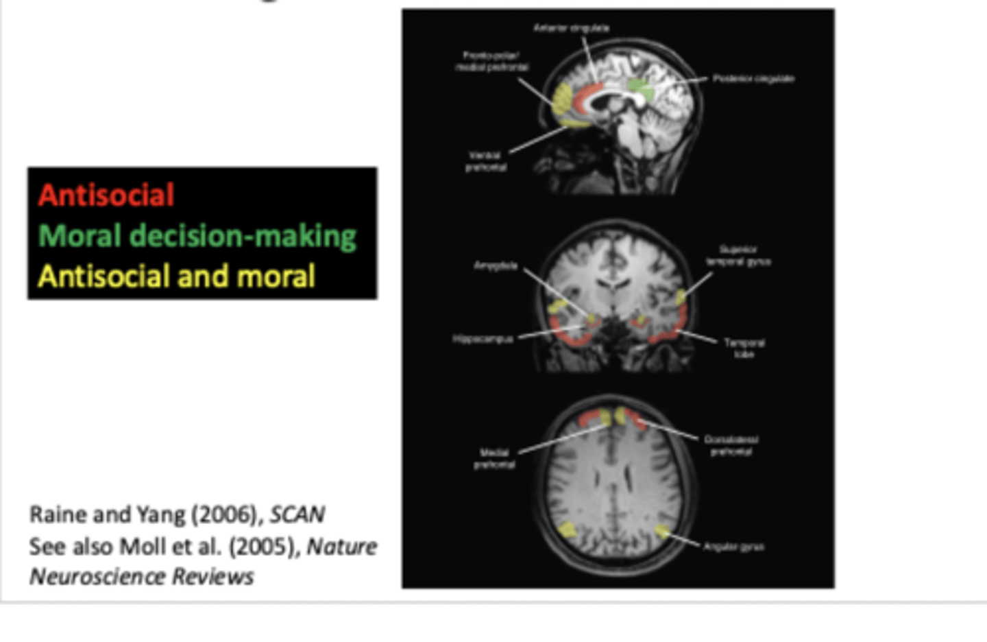 <p>- Angular gyrus</p><p>- Superior temporal gyrus</p><p>- Amygdala</p><p>- VMPFC</p>