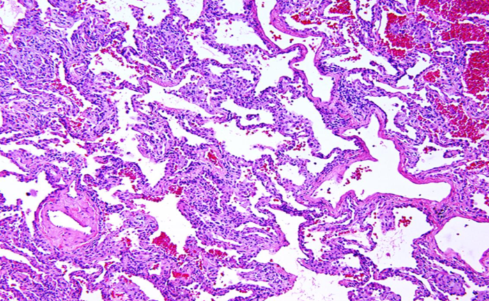 <p>Neumonía intersticial inespecífica tipo:</p>