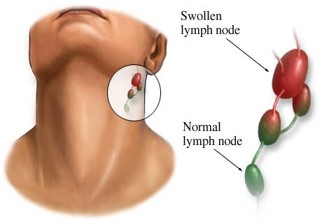 <ul><li><p>Means a disease of the lymph nodes</p></li><li><p>Lymph nodes become swollen/ enlarged and may be painful to touch</p></li></ul>