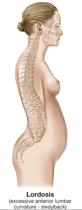 An exaggerated inward curve of the spine that typically affects the lower back, a condition called lumbar lordosis. 