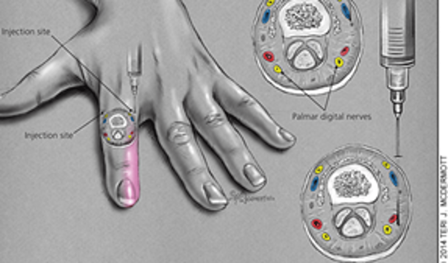 <p>1. Assess cap refill & 2 point discrimination on volar pad (prior to block) THEN -></p><p>2. Digital block (regional) anesthesia</p>