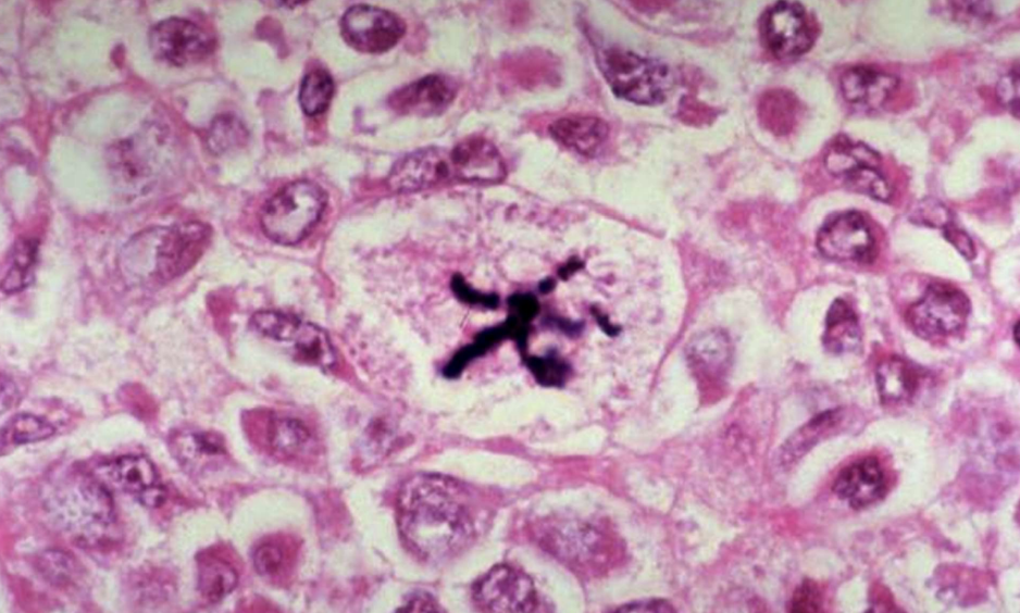 <p>Abnormal Mitotic Figures</p>