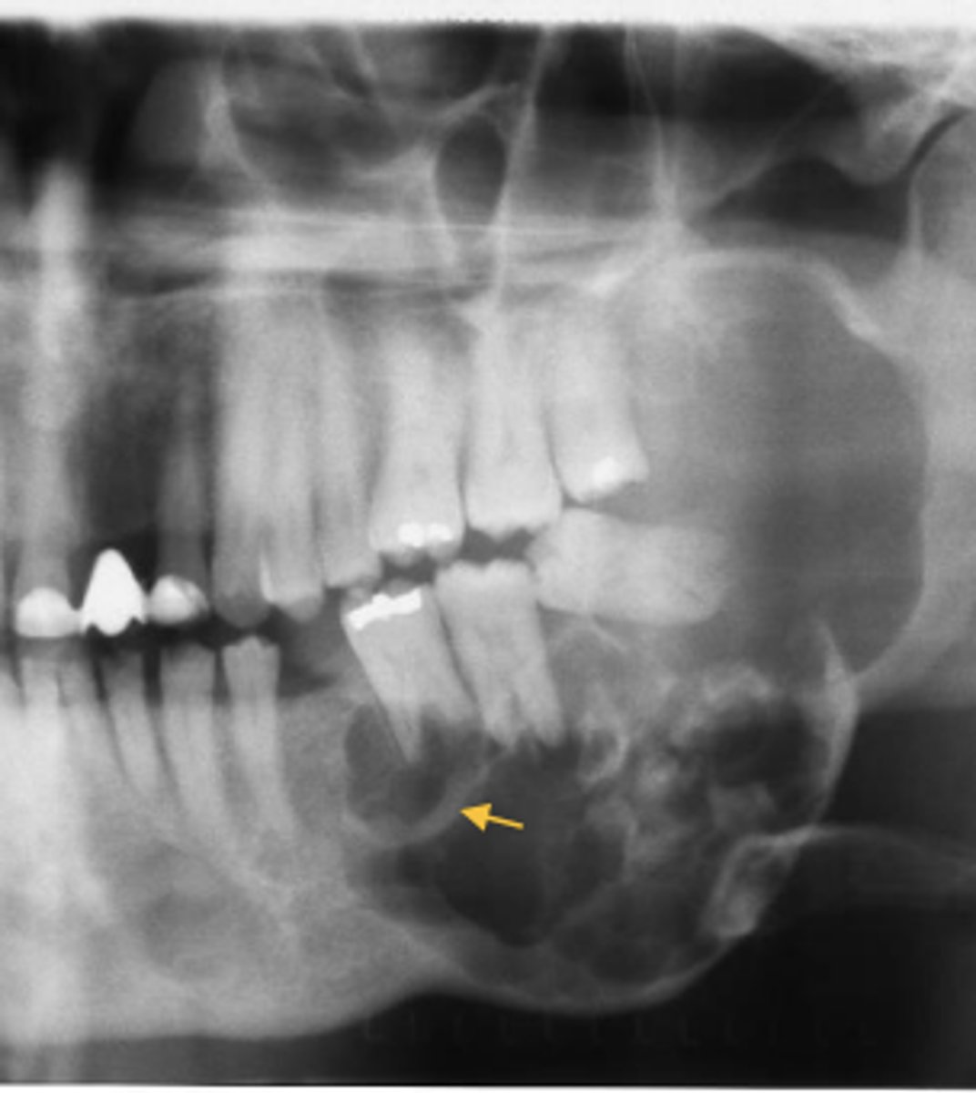 <p>• unilocular radiolucency (early lesions)</p><p>• multilocular radiolucency (honeycomb/soap bubble) (large lesions)</p><p>• cortical thinning/bone expansion</p><p>• resorption of adjacent tooth roots + tooth displacement</p>