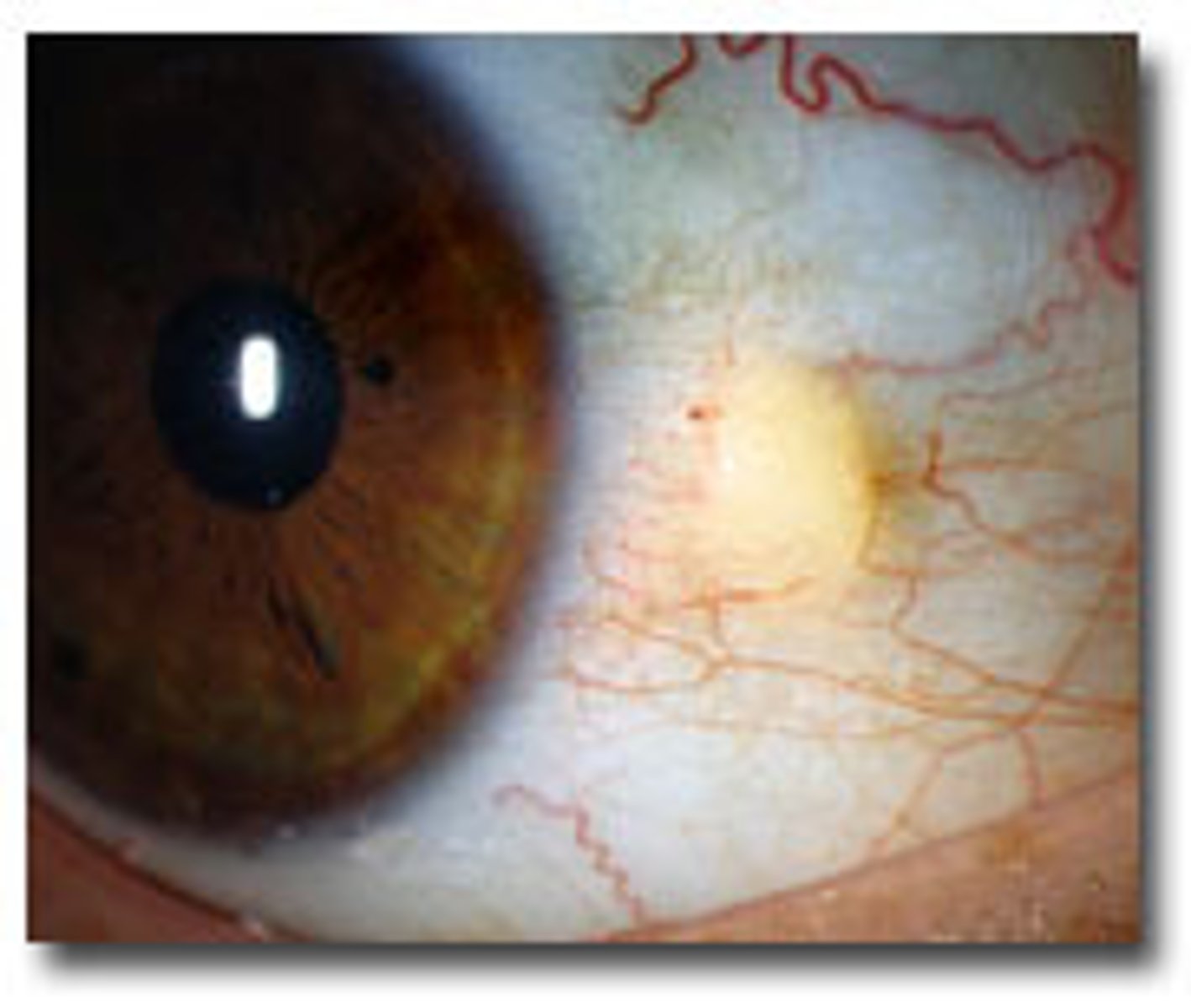 <p>Yellowish nodules that are thickened areas of the bulbar conjunctiva. Caused by prolonged exposure to sun, wind, and dust.</p>