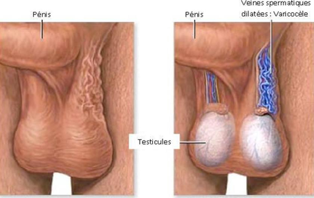<p>une dilatation anormale des veines du plexus pampiniforme, qui draine le sang des testicules. Elle ressemble à des varices situées dans le scrotum.</p>
