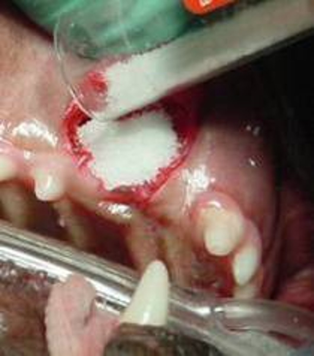 <p>Guided tissue regeneration</p><p>osseous or soft tissue graft</p><p>(the picture is of a dogs mouth, but still helpful as a visual)</p>