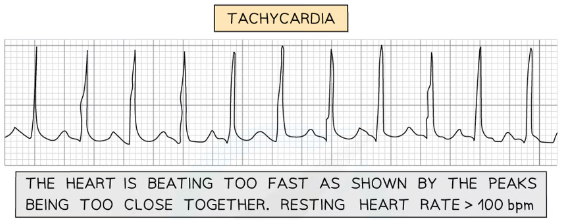 <ul><li><p>heart beat too fast</p></li><li><p>peaks of ECG too close together</p></li></ul>