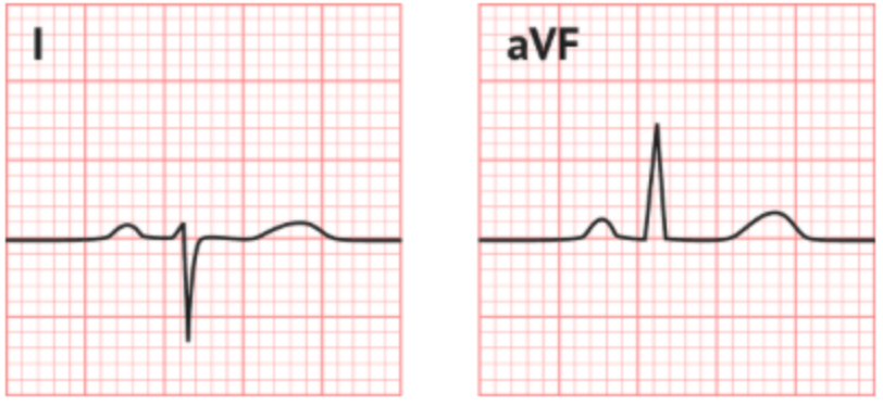 <p><span><span>What is the axis on the following ECG?</span></span></p>