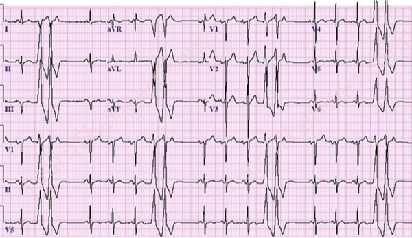 <p>What does this refer to “sinus rhythm with pairs of PVC’s”</p>
