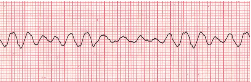 * cardiac arrest. no effective pumping action by the heart and thus there is no circulation
* lack of identifiable waves on EKG: appears erratic, rapid twitching of the ventricles
* requires immediate CPR and defribillation