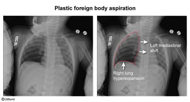 <p>unilateral lung hyperinflation → foreign body aspiration </p>