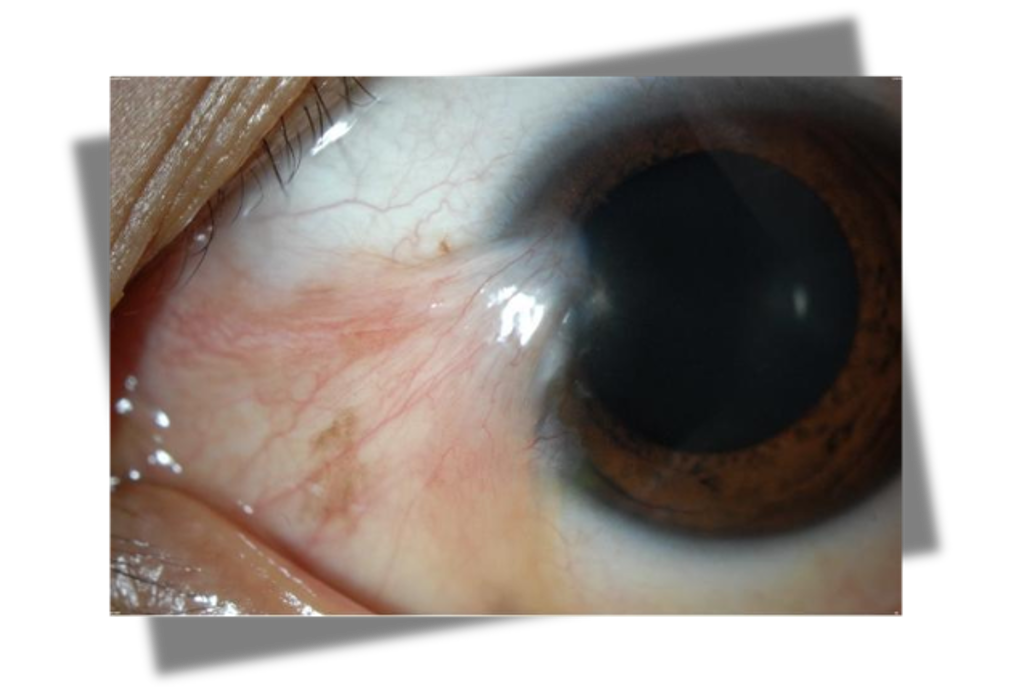 <p>triangular wedge on conjunctiva that crosses cornea</p>