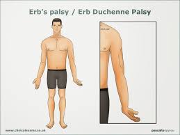 <p>Erb’s Palsy or Erb’s Duchenne Palsy or “Waiter’s tip” position is due to Injury of which Trunk of the brachial plexus? </p>