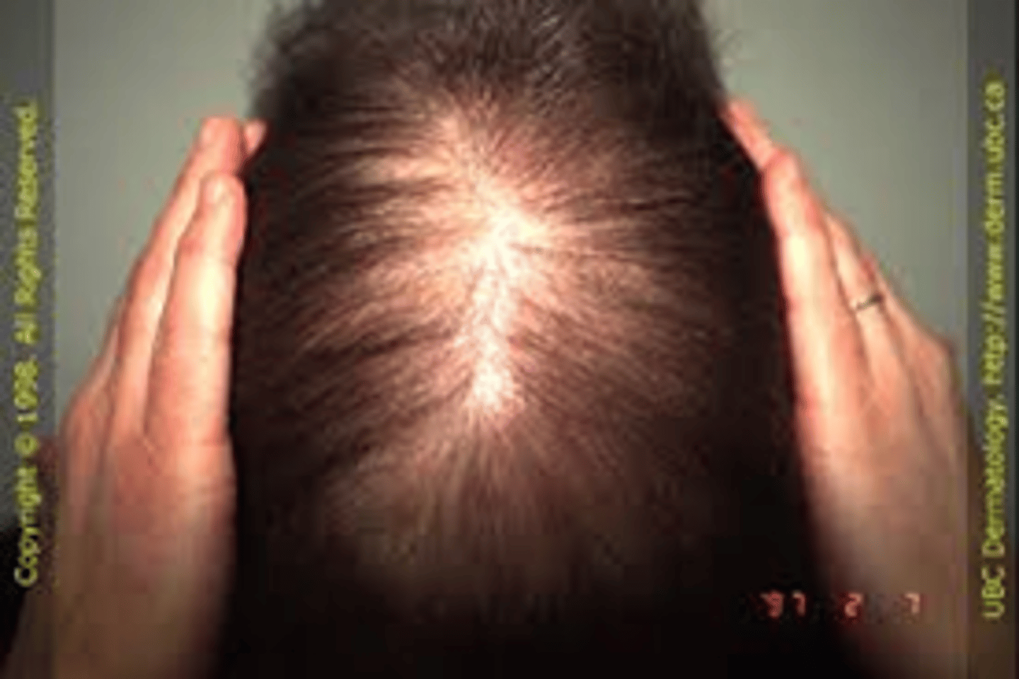 <p>diagnose this:</p><p>hair comes out in clumps in shower/brush</p>
