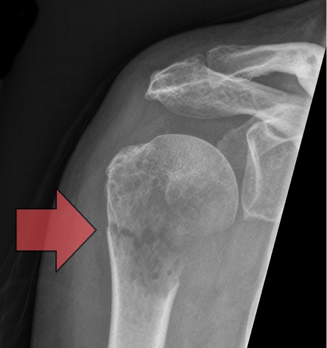 <p>fracture in bone due to a tumor or metabolic disorder</p>