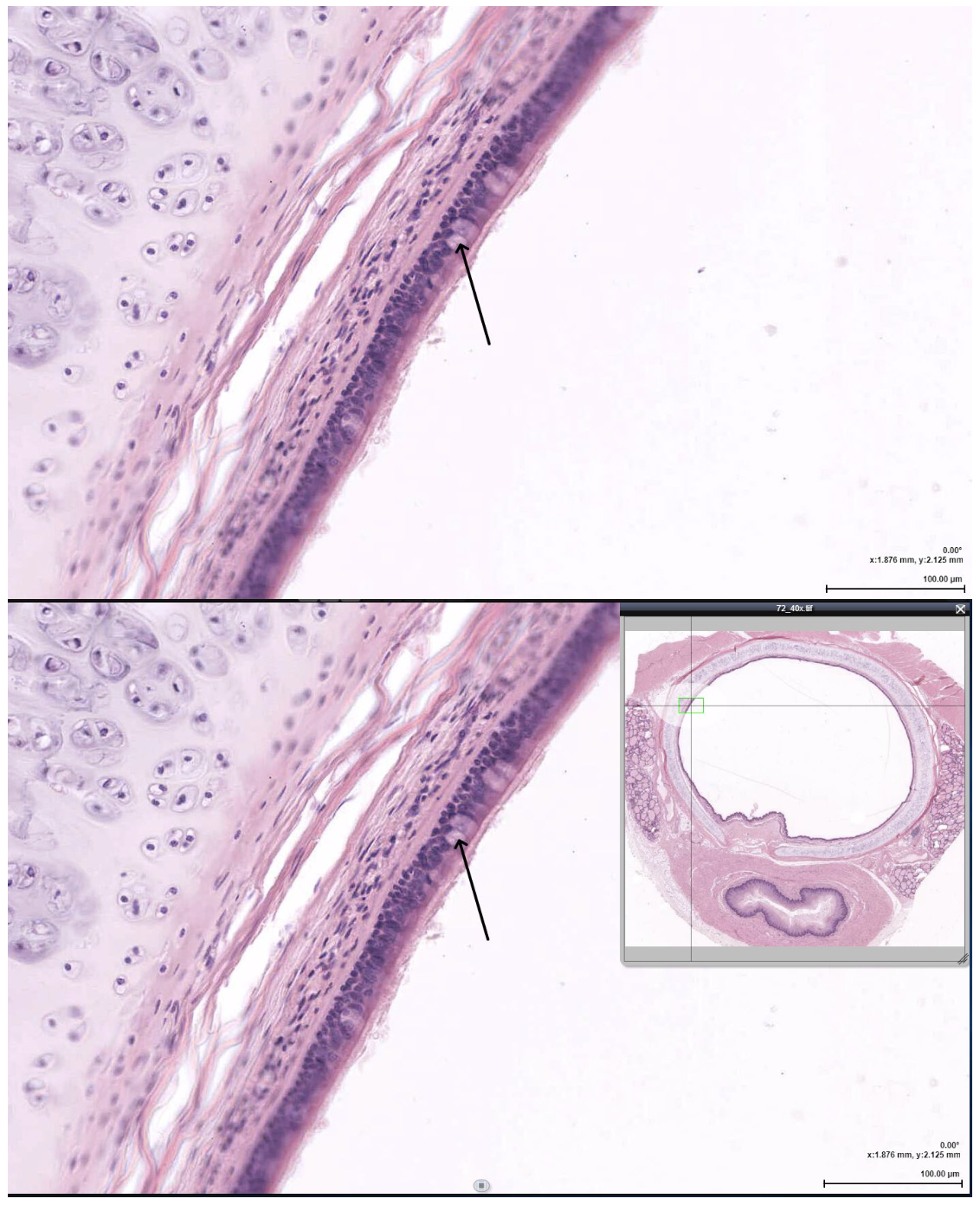 <p><span><span>The cell indicated by the arrow would LEAST likely be found in which of the following?</span></span></p>
