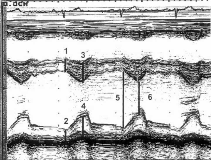 <p>label LV size M-Mode</p>