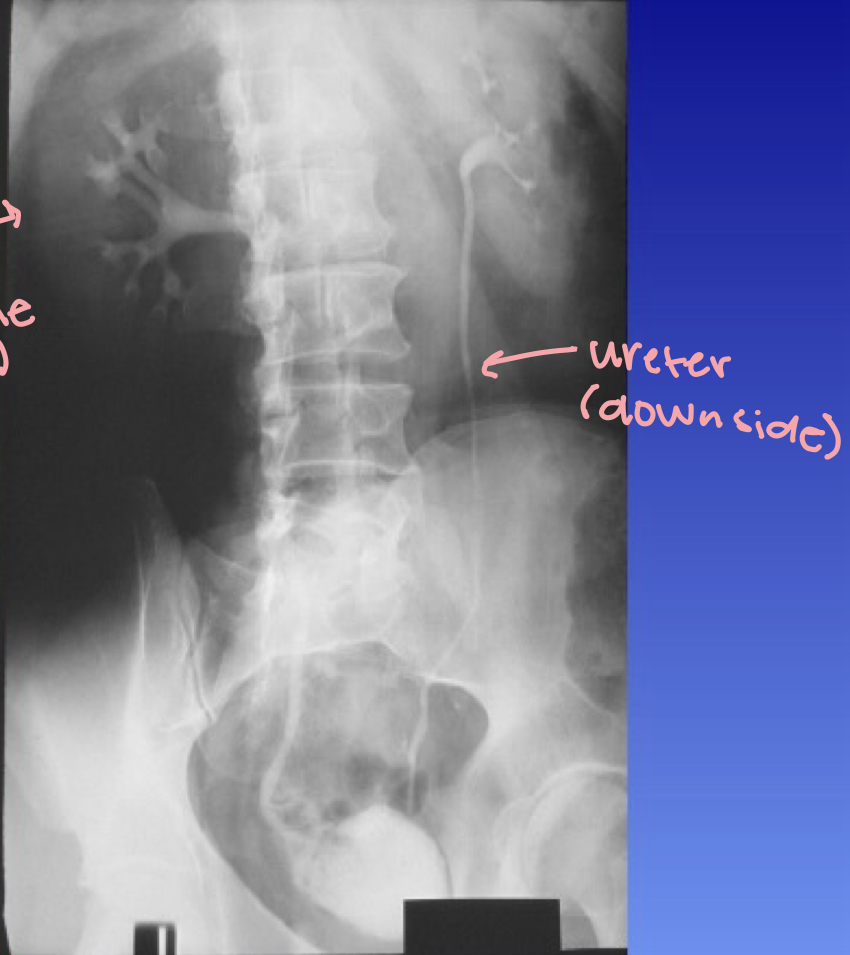 <p>What is this X-ray demonstrating?</p>