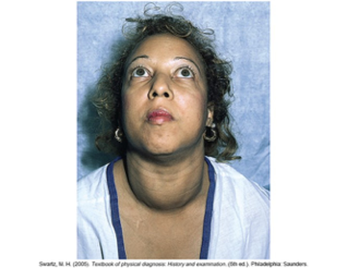 <p>thyroid disorder: graves disease (appearance)</p>