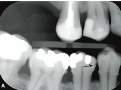 <p>caries classification?</p>