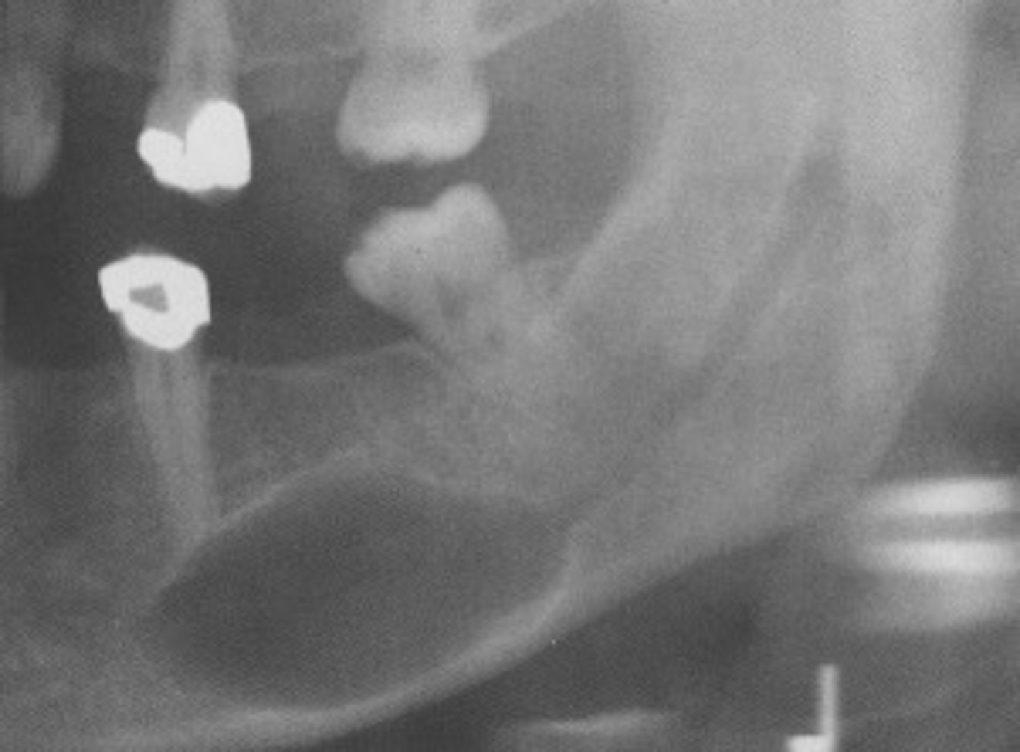 <p>Patient presents with a radiolucent, well defined, corticated, fusiform enlargement of the neurovascular (IAN) canal. What is the diagnosis?</p>