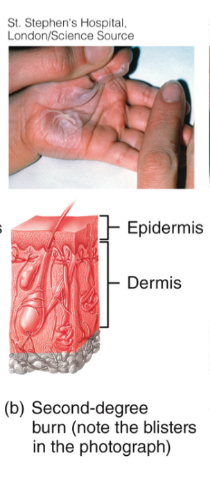 <p>-epidermis + part of dermis</p><p>-some skin functions lost, redness, blisters, swelling</p>