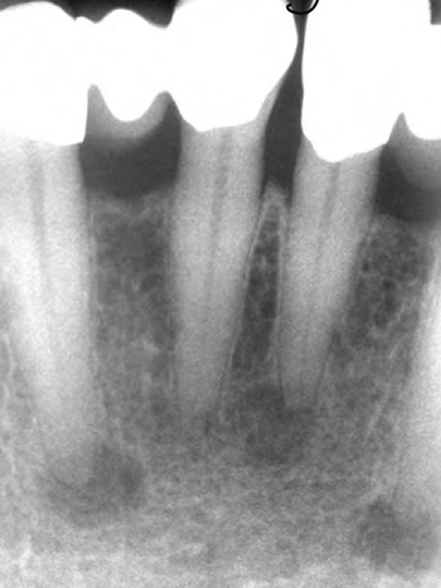 <p>Lesions confined to the periapices of MN anterior teeth</p>