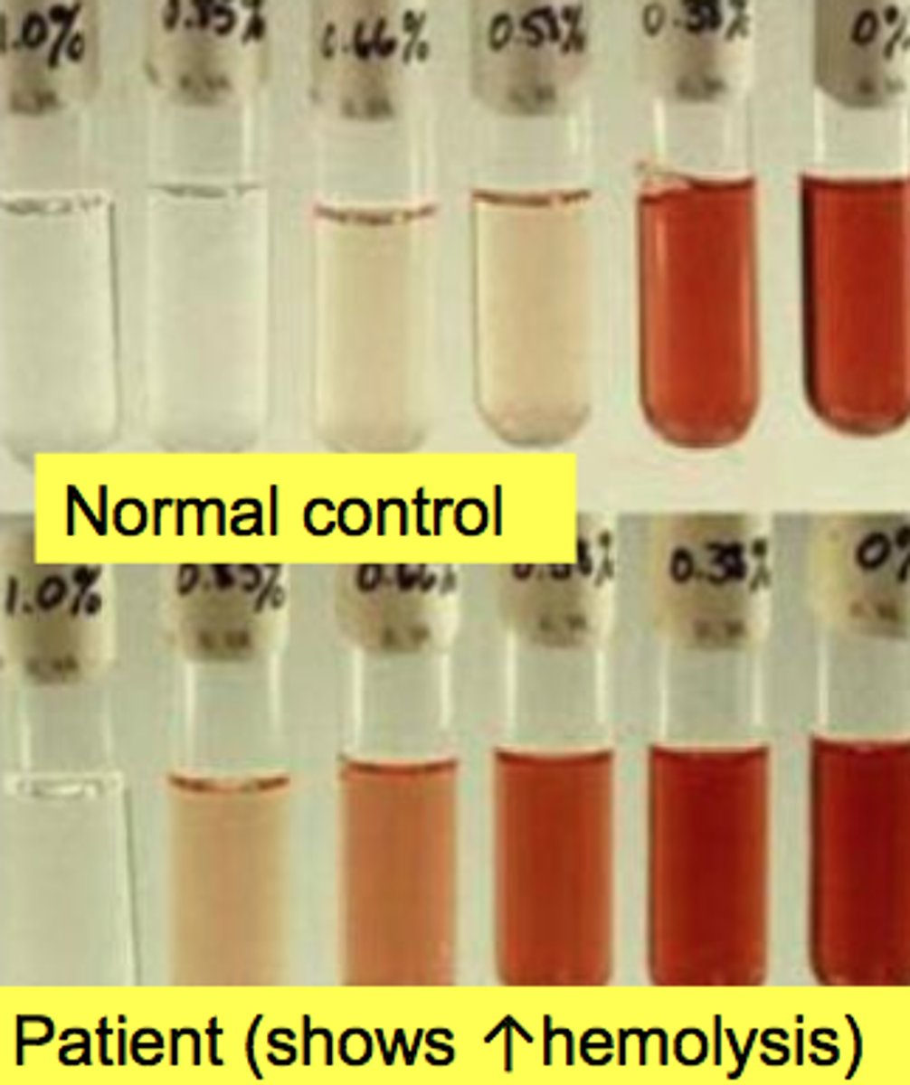<p>Normal Cells begin lysis at 0.45-0.55% NaCL</p>