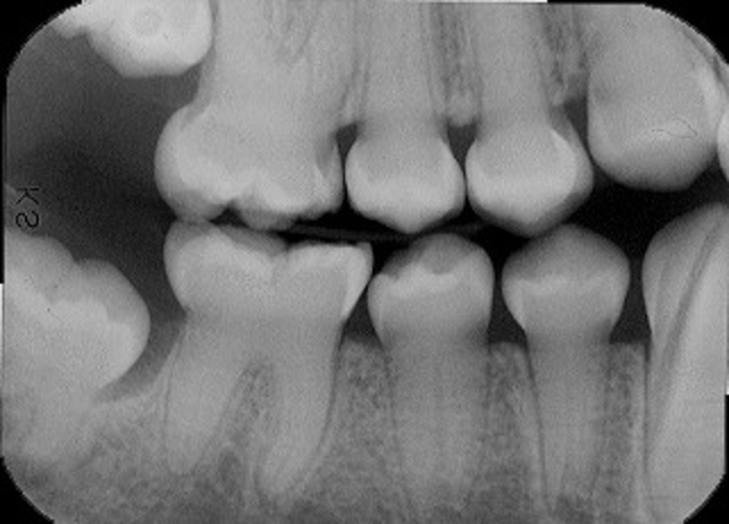 <p>Dentinogenesis imperfecta</p>