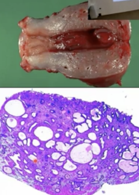 What are the risk factors of an endometrial polyp ? 