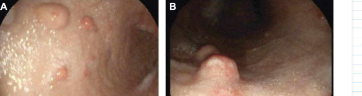 <p>more gastric NET, often immune with anti-parietal cell or anti-intrinsic factor antibodies leading to low or absent acid secretion; atrophic gastritis</p>
