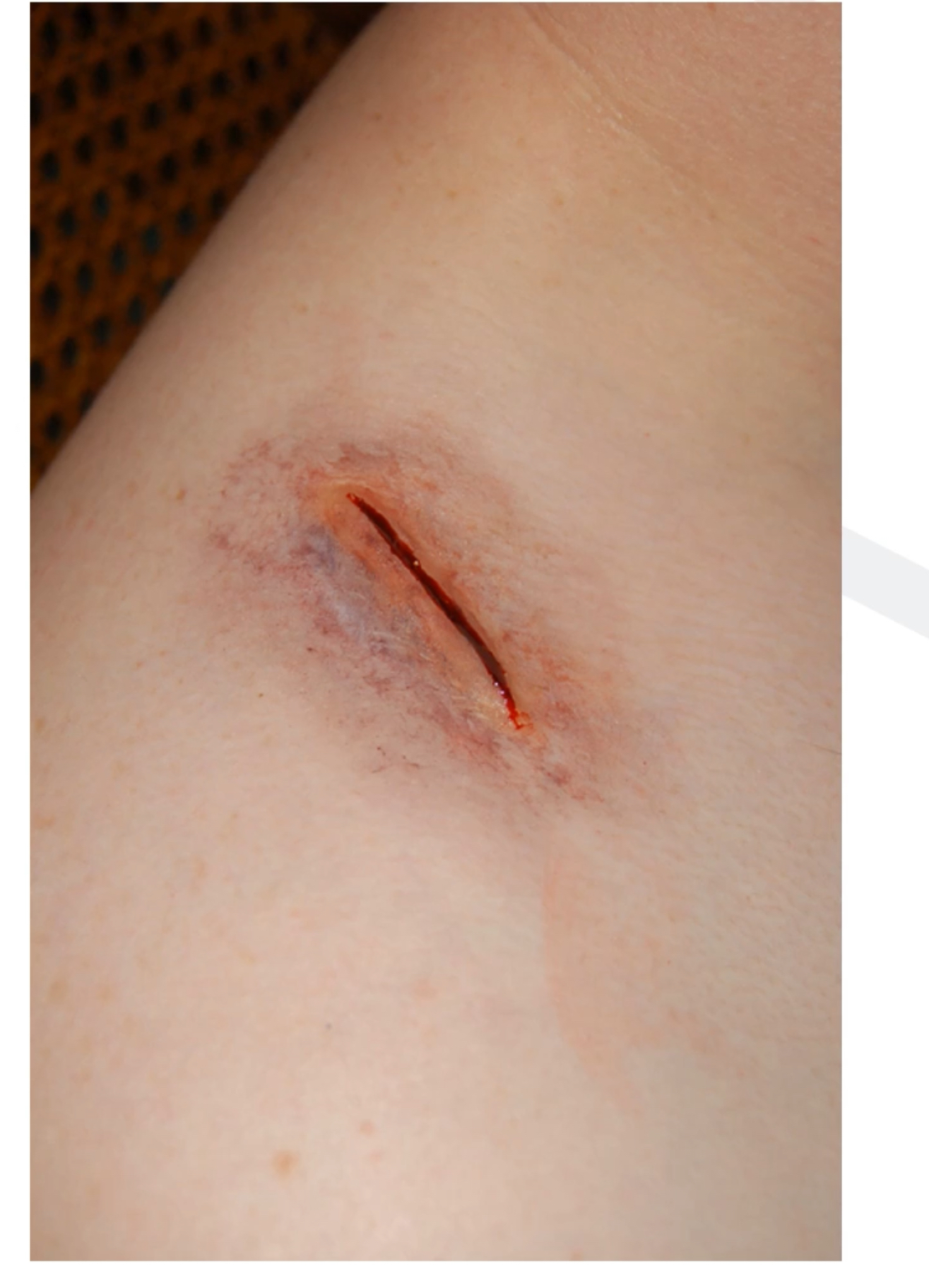 <p>Bruising around the wound, cannot tell what structures affected as very fine and difficult to pinpoint, done with force</p>
