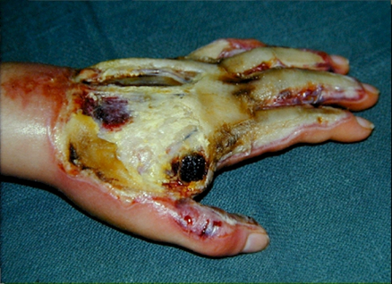 <p>3rd degree burns-Symptoms </p>