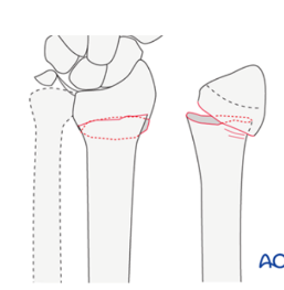 <p>Does not go into the joint surface</p>