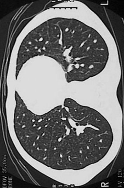 <p>8.10 Side A (PBD9: 360; BP9: 503)<br></p>
<p><br></p>
<p>Questions<br></p>
<p>A 42-year-old man has fever, cough, and dyspnea for 3 weeks. CT shows diffuse reticulonodular pattern.<br></p>
<p><br></p>
<p>1. What radiographic pattern is present?<br></p>
<p>2. What fungi cause this?<br></p>
<p>3. What diseases predispose?<br></p>