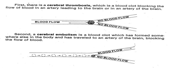 <p>Ischemic Stroke </p>