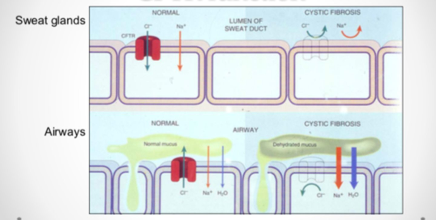 <p>In CF, the mucus is dehydrated due to the lack of chloride movement, Na+ and water do not follow it out</p>