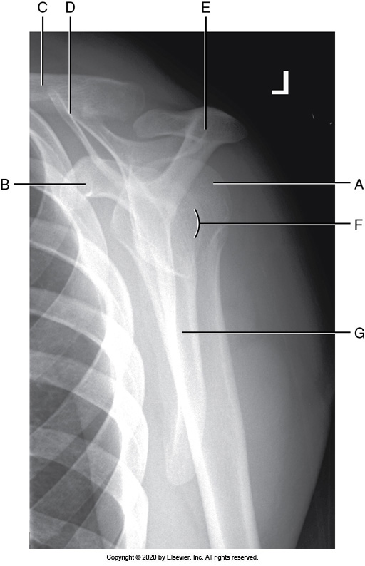 <p>Identify the labeled "E"&nbsp; anatomy in the image below:</p><p>Scapular body</p><p></p><p>Acromion process</p><p>&nbsp;</p><p>Superior scapular angle</p><p>&nbsp;</p><p>Coracoid process</p>