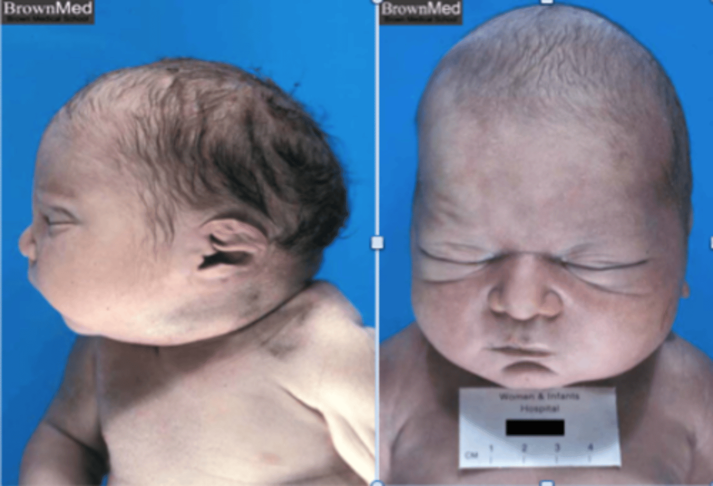 <p>Wide-set eyes, prominent inner canthus, beaked nose, large low-lying ears, spine/limb contractures, pulmonary hypoplasia; oligohydramnios</p>