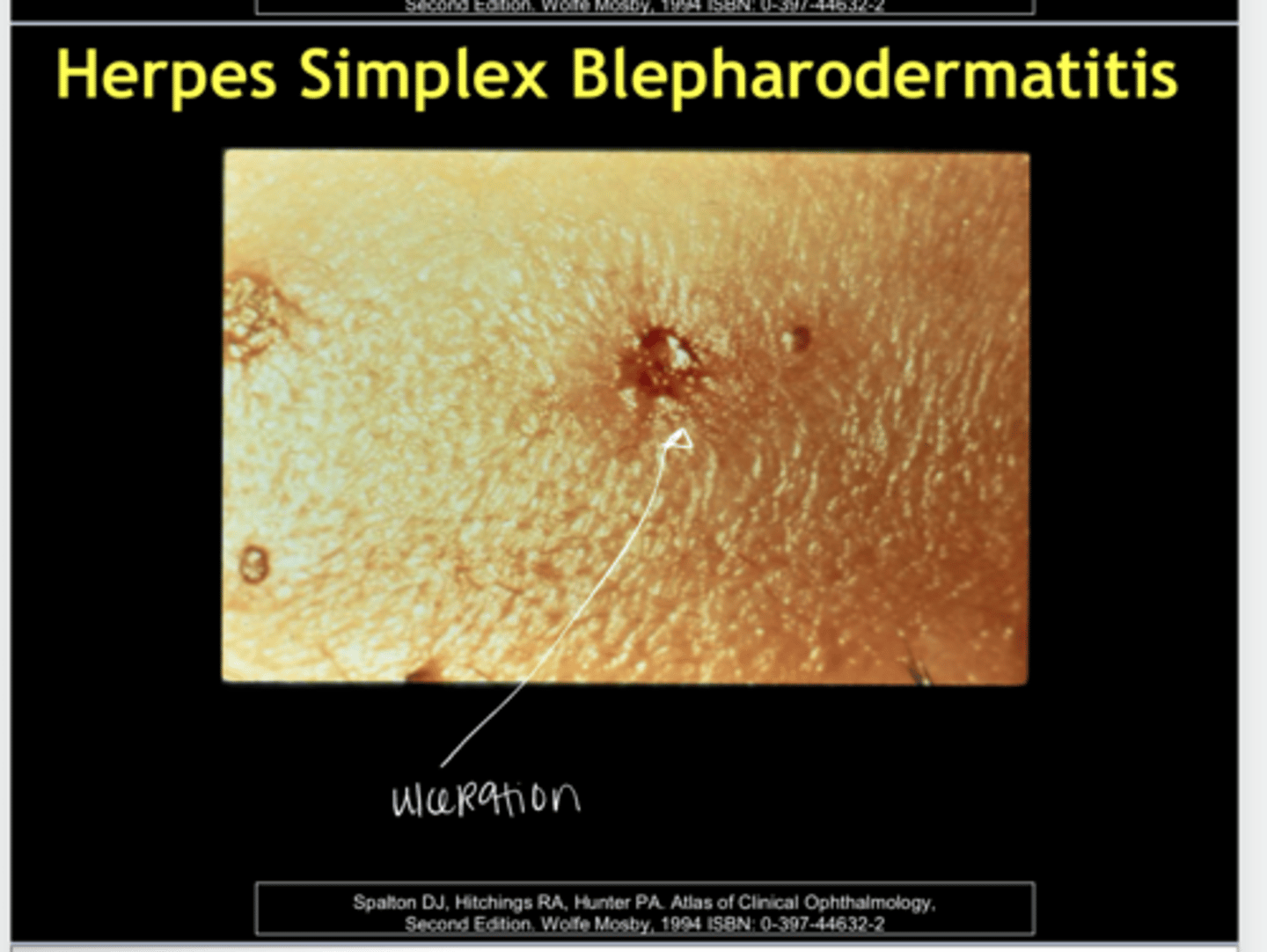 <p>Herpes Simplex Blepharodermatitis -- Ulcerations (Pic)</p>