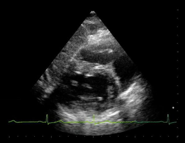 <p>What acoustic phenomenon causes the abnormal appearance of the LV?</p>