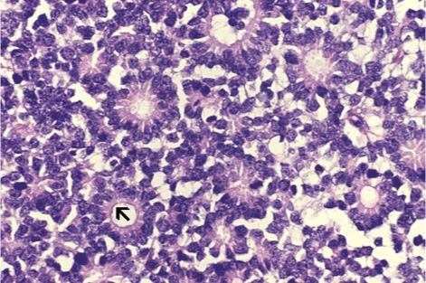 <p>What does this refer to</p><img src="https://knowt-user-attachments.s3.amazonaws.com/deacba5a-4cd8-42ca-a1f8-72749547c6eb.png" data-width="100%" data-align="center"><ul><li><p>Histology </p><ul><li><p>Classic histologic finding (ocular tissue)</p><ul><li><p>Flexner-Wintersteiner rosettes</p></li><li><p>Spoke and wheel shaped cell formation</p></li></ul></li></ul></li></ul><p></p>