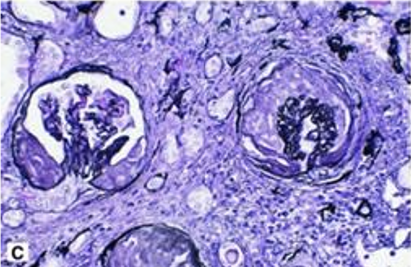 <p>What pathology is shown here?</p>