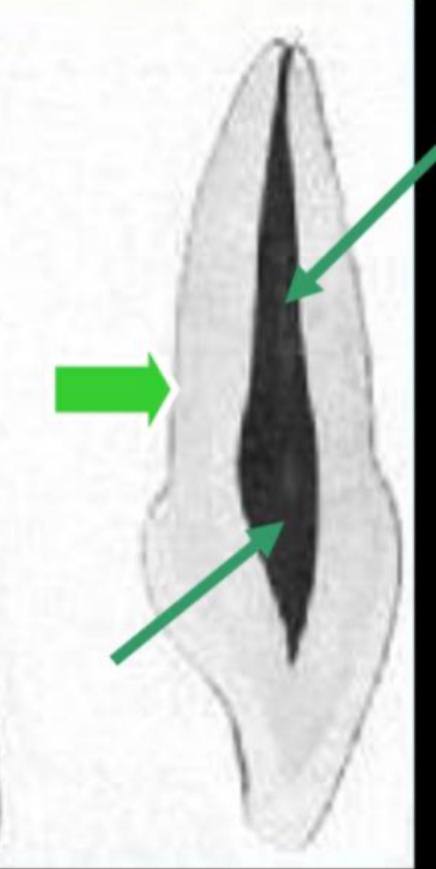 <p>labiolingual section of pulp cavity</p>