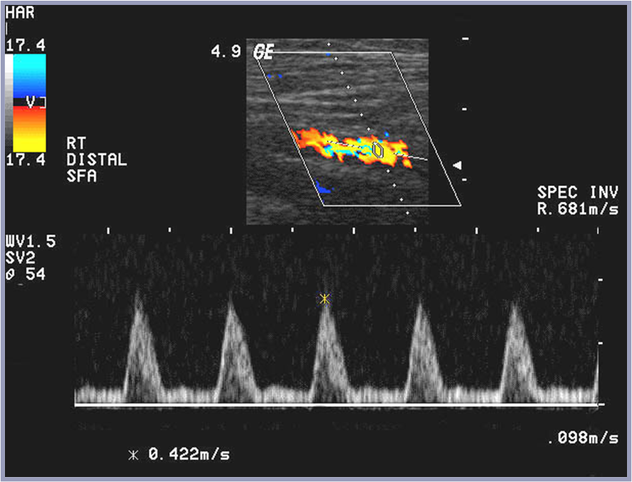 forward flow through cardiac cycle from vasodilation distally