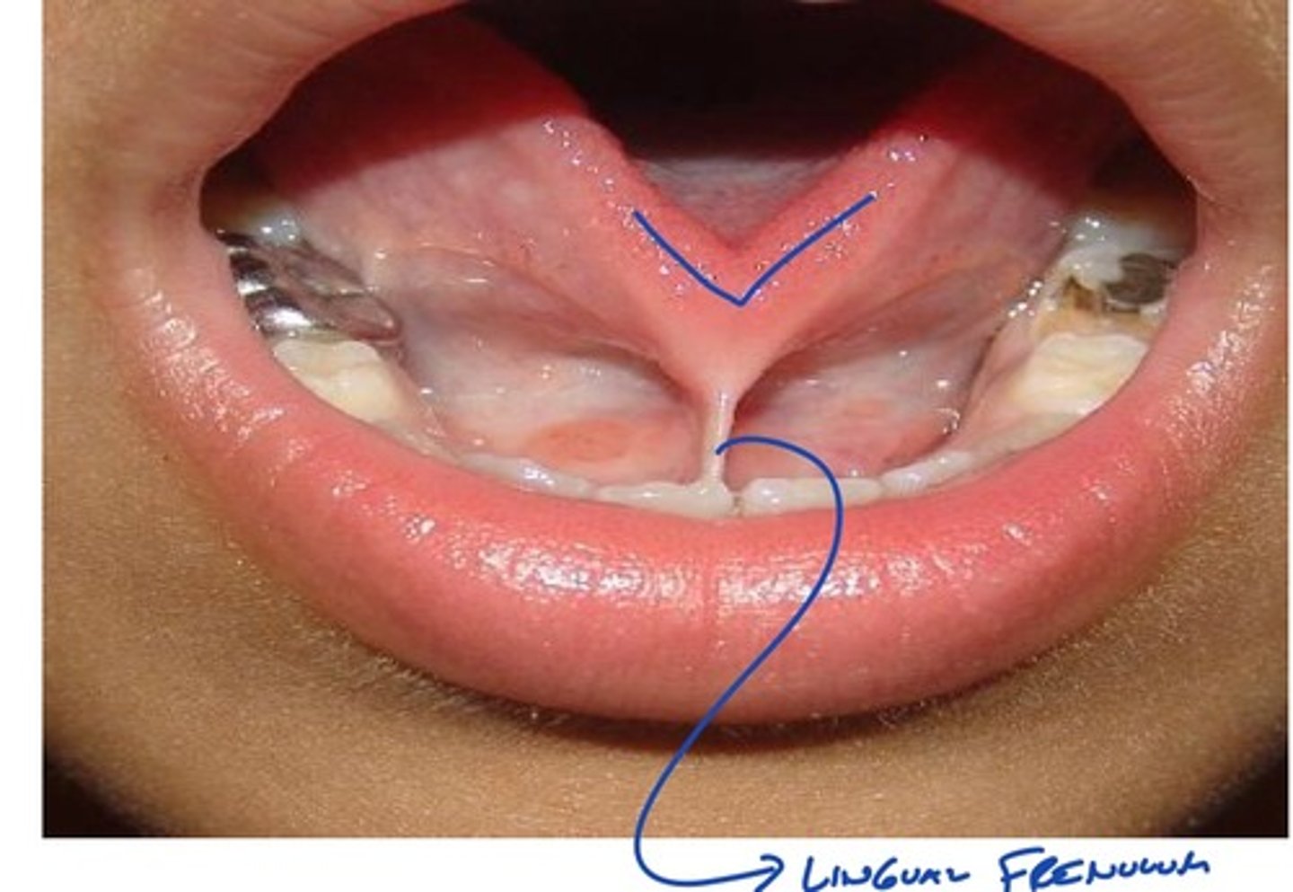 <p>-seen in children</p><p>-tongue tied: creates speech problems</p><p>-can get it clipped</p>